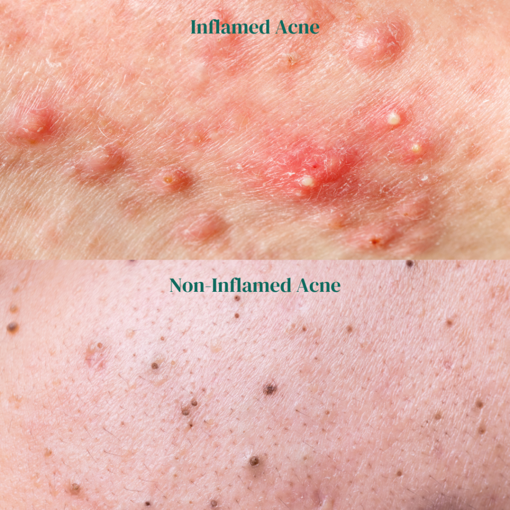 The image shows an example of inflamed acne vs. non-inflamed acne